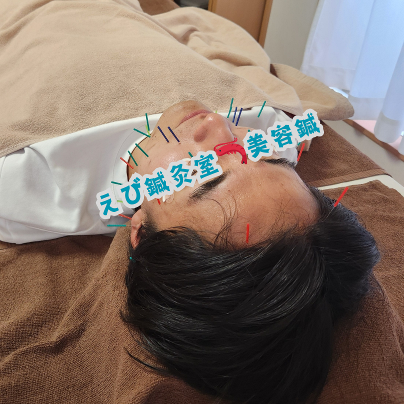 メンズ美容鍼(^▽^)