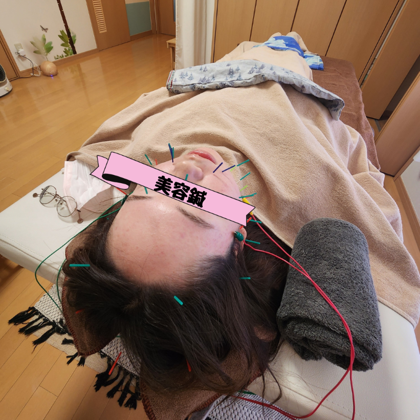 一年越しの美容鍼