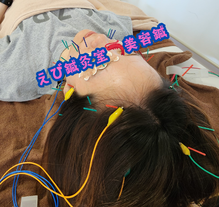 眼瞼下垂にも美容鍼