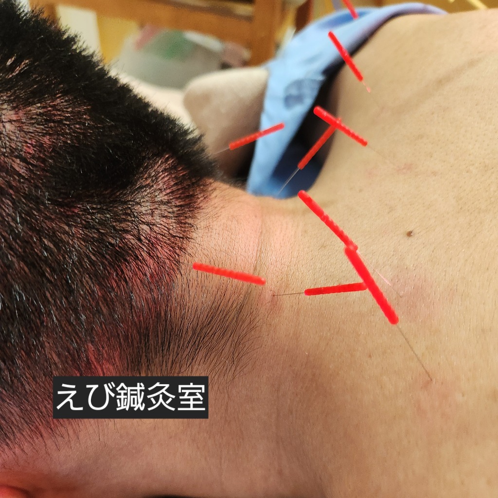 中腰でお仕事の方は是非鍼灸を