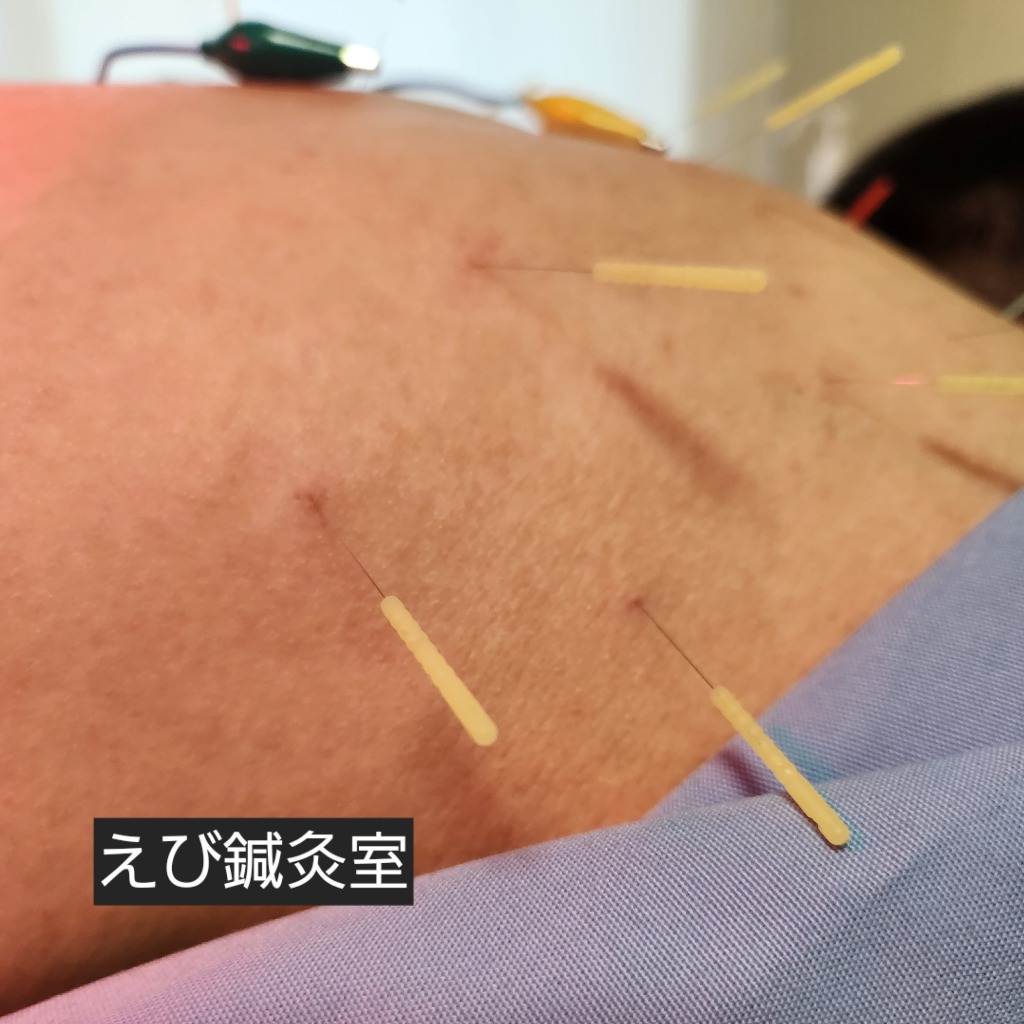 中腰でお仕事の方は是非鍼灸を