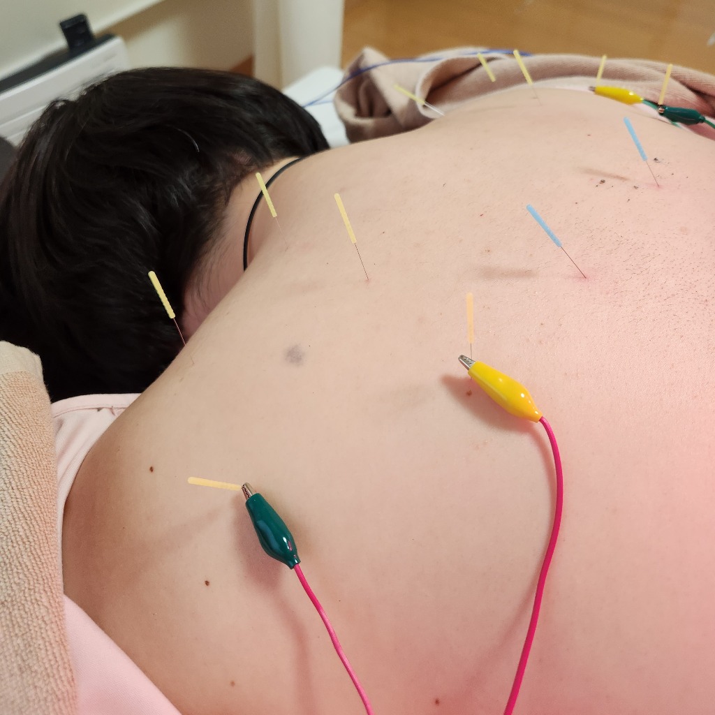30代女性リピーターさん鍼灸コース