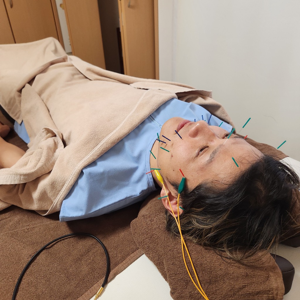 鍼灸&美容鍼 30代男性